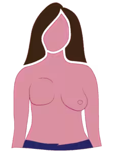 Diagram of radical mastectomy fullness surgical side