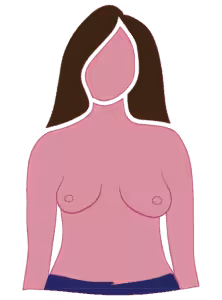 Diagram of radical mastectomy mostly asymmetry small remaining breast