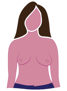 Diagram Of Radical Mastectomy Mostly Asymmetry Small Remaining Breast