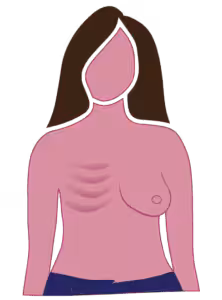 Diagram of radical mastectomy mostly concave chest wall