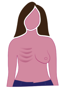 Diagram Of Radical Mastectomy Mostly Concave Chest Wall