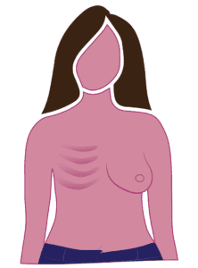 Diagram Of Radical Mastectomy Mostly Concave Chest Wall