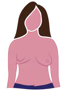 Diagram of radical mastectomy mostly excess skin on chest wall
