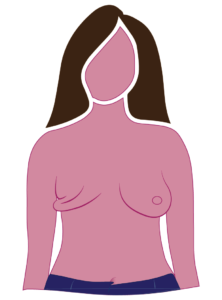 Diagram Of Radical Mastectomy Mostly Excess Skin On Chest Wall