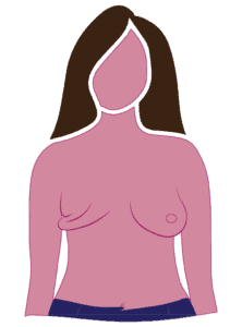 Diagram Of Radical Mastectomy Mostly Excess Skin On Chest Wall