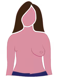 Diagram of radical mastectomy mostly flat surgical side