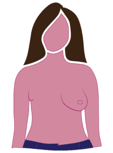 Diagram Of Radical Mastectomy Mostly Flat Surgical Side