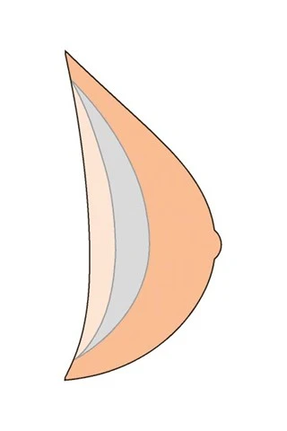 Natura breast form profile